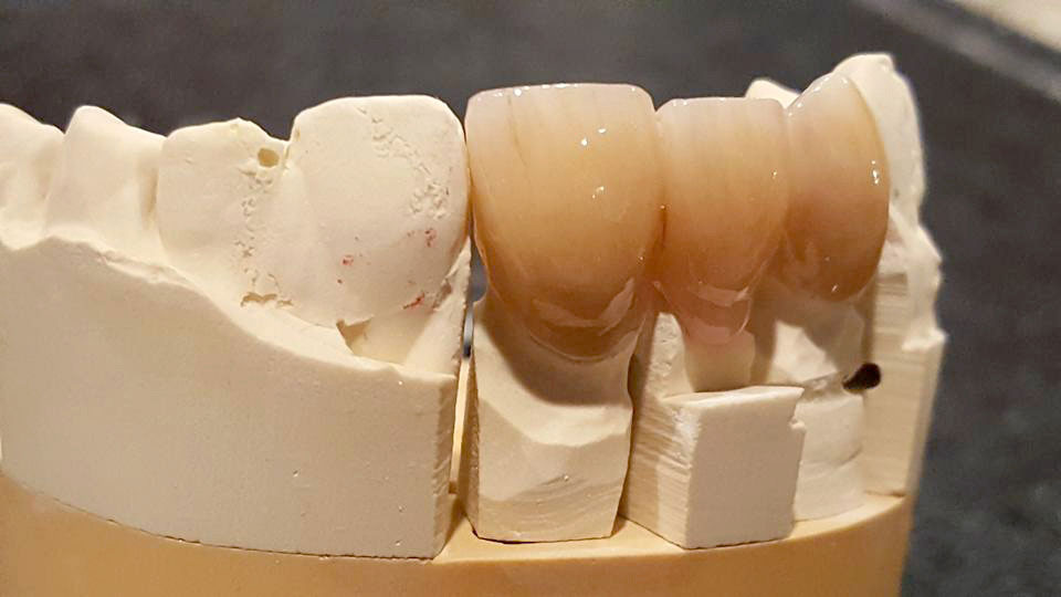 Full contour zirconia bridge with cut back incisal edge, then incisal porcelain laid with pink tissue.